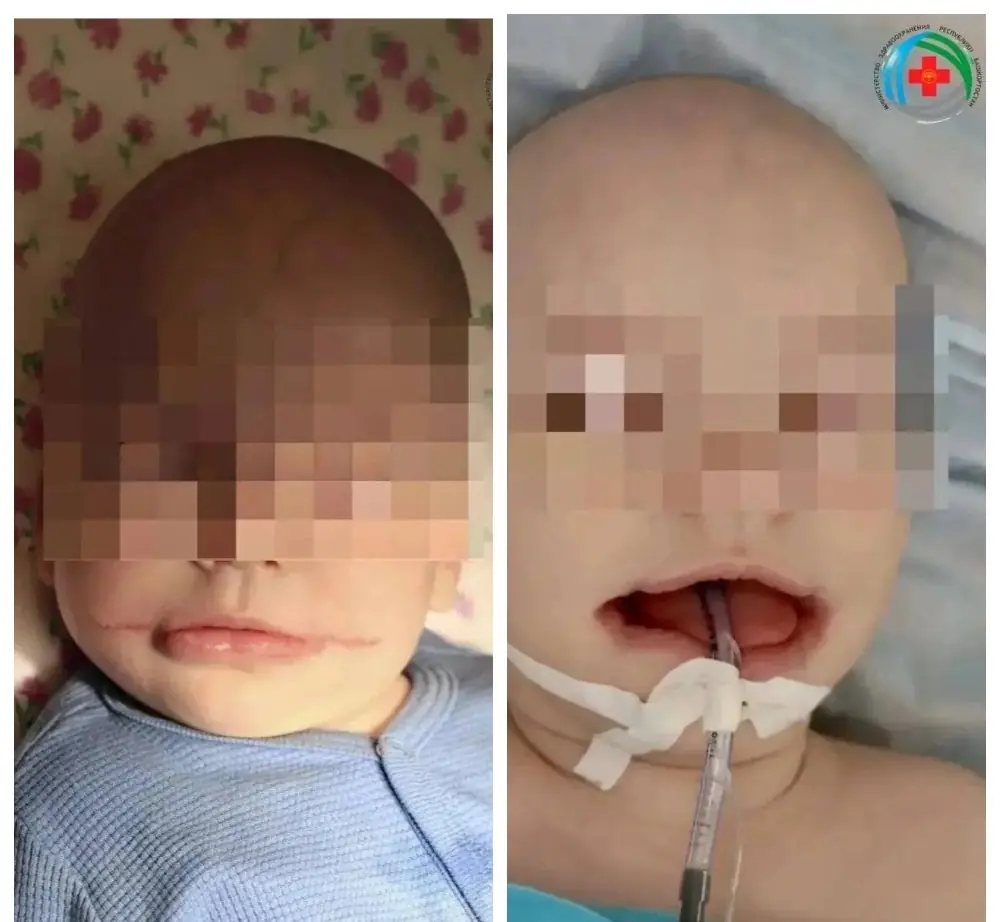 В Башкирии врачи собрали по кусочкам лицо 8-месячного ребенка