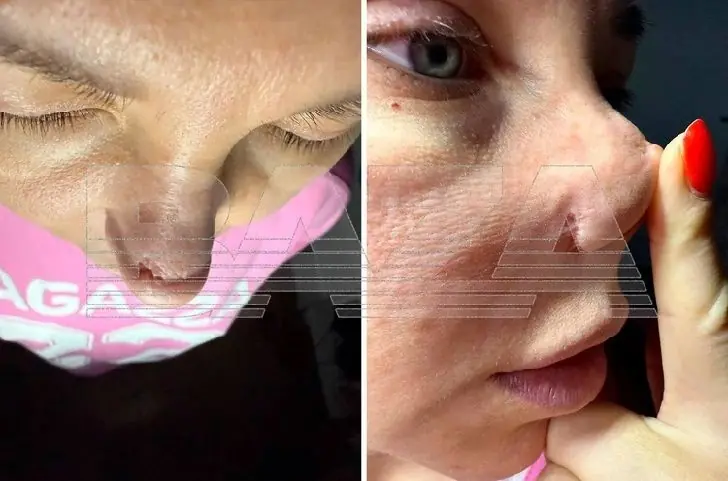 Уфимка заплатила 900 тысяч за изуродованный нос