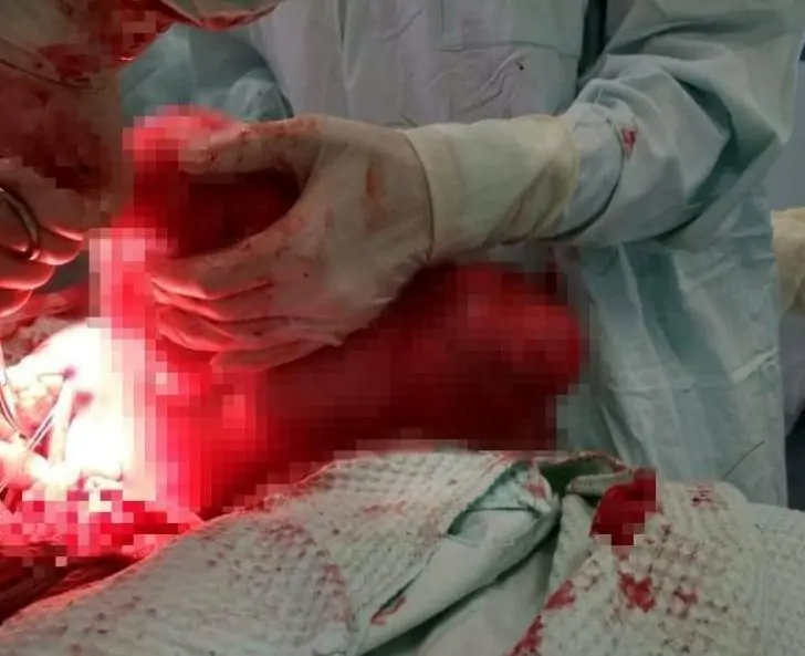 В Башкирии обнаружили женщину с огромной опухолью в матке