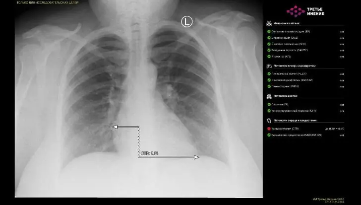 Наступило будущее? В Башкирии искусственный интеллект успешно расшифровал рентгеновский снимок
