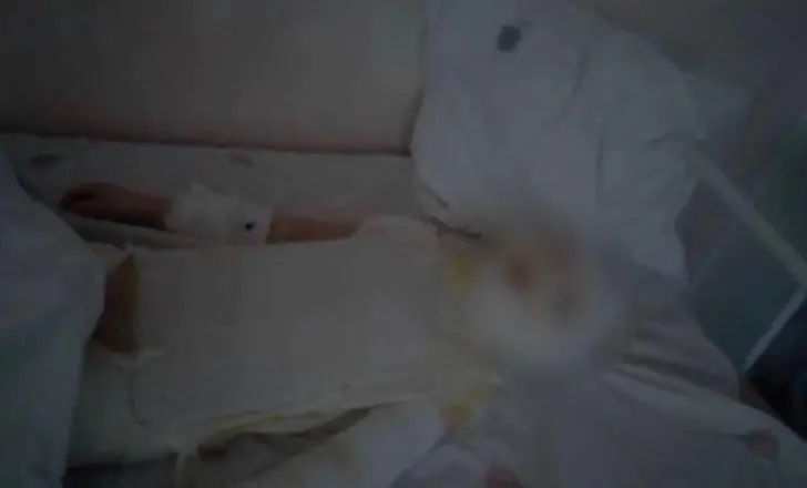 Стало известно состояние мальчика, получившего ожоги в бане в Башкирии