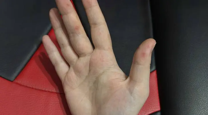 Коксаки пришел за нами? В районах Башкирии новый вирус косит всех страшными волдырями и температурой