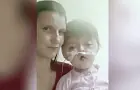 Уфимские врачи сделали первую операцию девочке с деформированным лицом