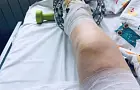 Мальчику, пострадавшему в аттракционе Стерлитамака, сделали пересадку кожи 