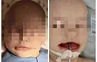 В Башкирии врачи собрали по кусочкам лицо 8-месячного ребенка